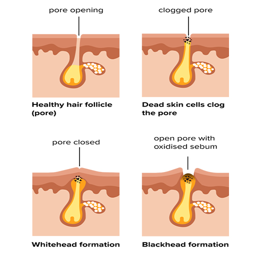 Causes & Treatment of Blackheads & Whiteheads - Eshaistic Blog Causes & Treatment of Blackheads & Whiteheads - Eshaistic Blog