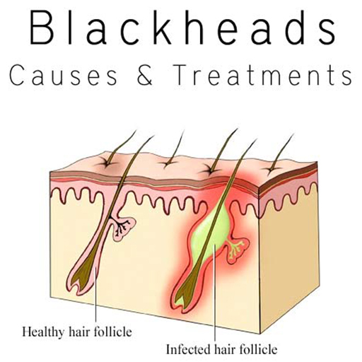 Causes & Treatment of Blackheads & Whiteheads - Eshaistic Blog