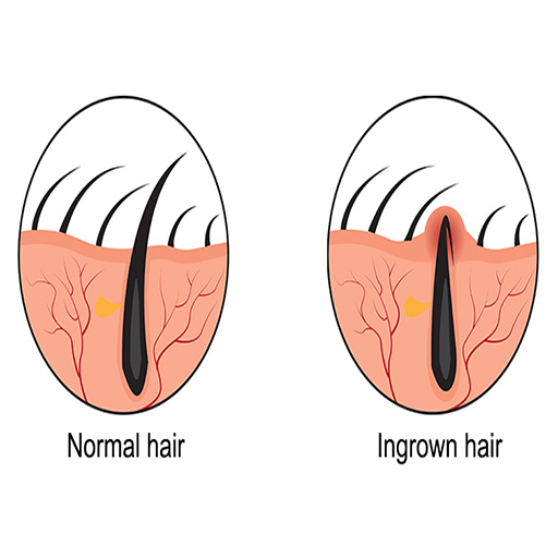 Ingrown Hairs: Causes, Prevention and Treatments - Eshaistic Blog