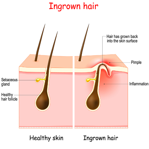 Ingrown Hairs: Causes, Prevention and Treatments - Eshaistic Blog