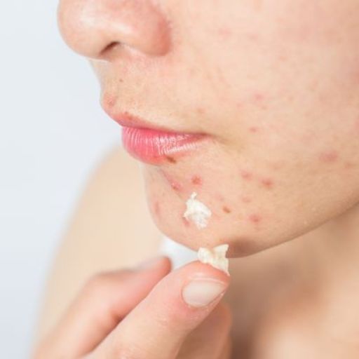 girl using cream to conceal blemishes